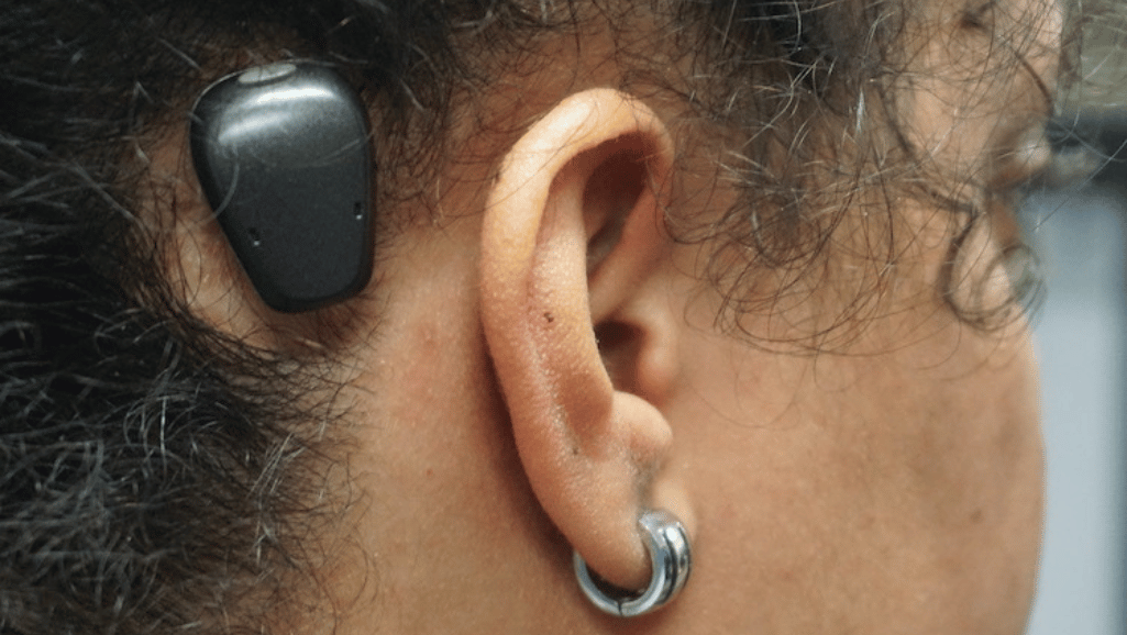 BAHA Hearing Aid