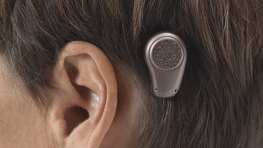 hearing improvement after BAHA